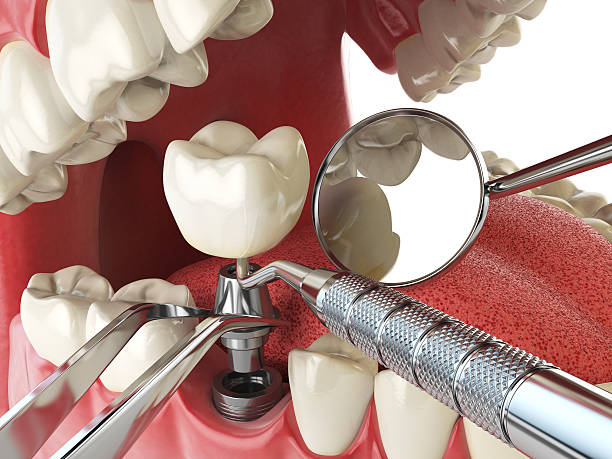 Best Chipped Tooth Repair Near Me  in El Dorado Springs, MO